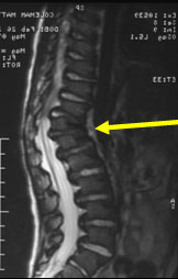 Congenital kyphosis at the junction of the thoracic and lumbar spine.